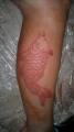 scar tattoo